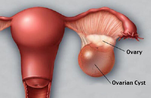 How to Prevent and Detect Ovarian Cysts in Time