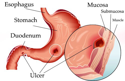 Natural Treatments to Help Relieve Gastric Ulcers