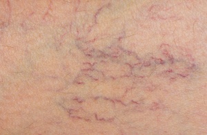 Great Natural Treatments for Varicose Veins