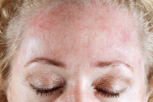 Skin allergy