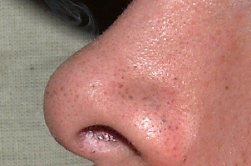 Lemons to fight blackheads