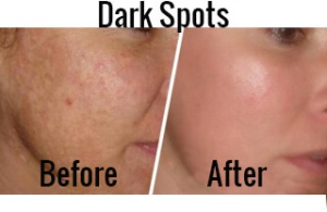 Natural Remedies that May Help Reduce Dark Spots