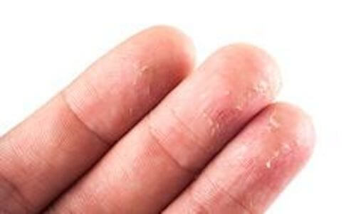 How to Eliminate Eczema Naturally