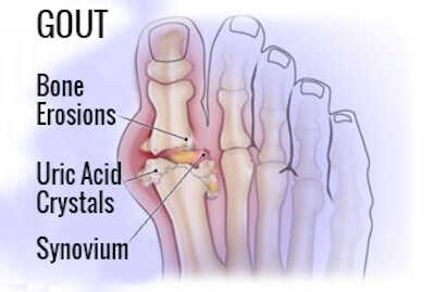 Formation of uric acid crystals