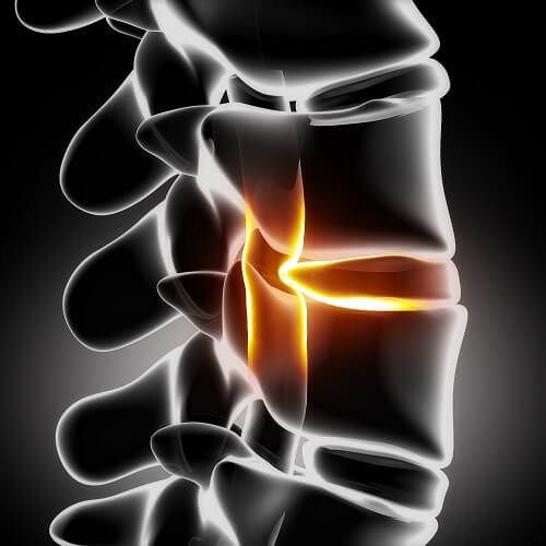 Herniated disc with pressure on spinal cord close-up