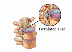 Symptoms of a Herniated Disc