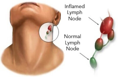 what causes shotty lymph nodes