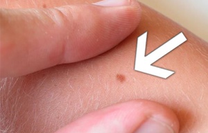 How to Identify Dangerous Moles