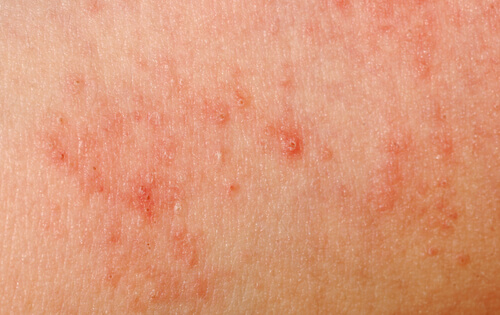 The 10 Most Common Skin Allergies