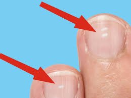 white marks on your fingernails