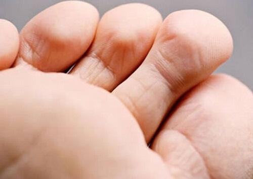 Bad foot odor.