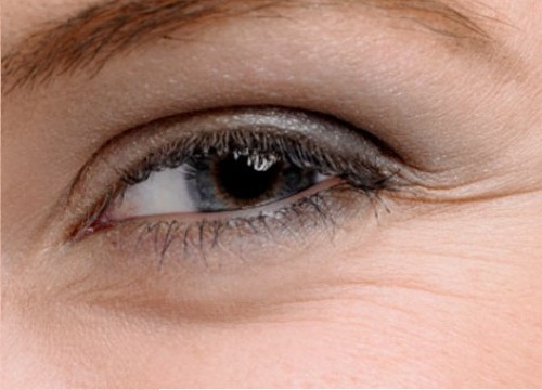 Remedies for Bags Under the Eyes and Crow's Feet
