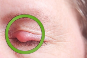 How to Quickly Cure a Sty With These Home Remedies