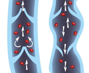 10 Best Remedies for Treating Varicose Veins
