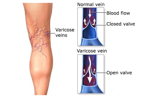 Varicose veins
