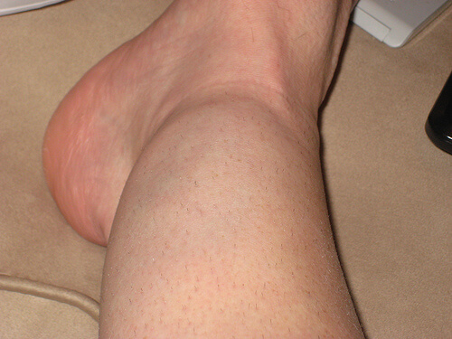 A man with a swollen ankle.