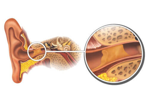 Ear wax plug diagram