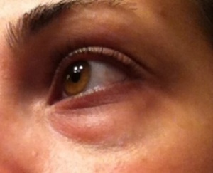 How to Hide Eye Bags Naturally