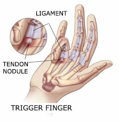Hand and wrist pain, trigger finger