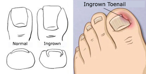 Treatments for Ingrowing Toenails - Step To Health
