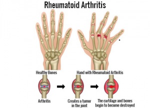 What Are the Possible Triggers of Rheumatoid Arthritis?
