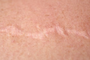 How to Use Onions to Treat Scars
