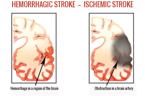 Different kinds of strokes
