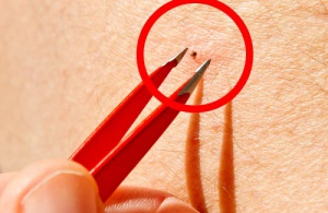 Ticks: A Real Danger to Humans and Animals