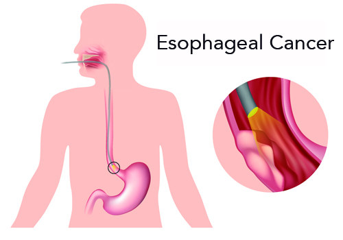 Symptoms of the Most Significant Esophagus Diseases