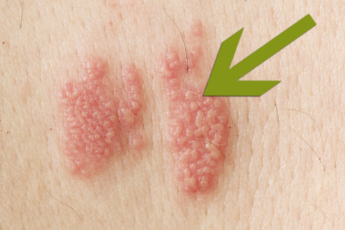 Shingles: what are they and how do they look? Shingles: what are they and how do they look?