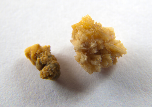 Kidney stones