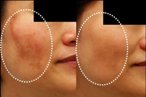 Reduce Skin Discoloration With These 5 Homemade Masks