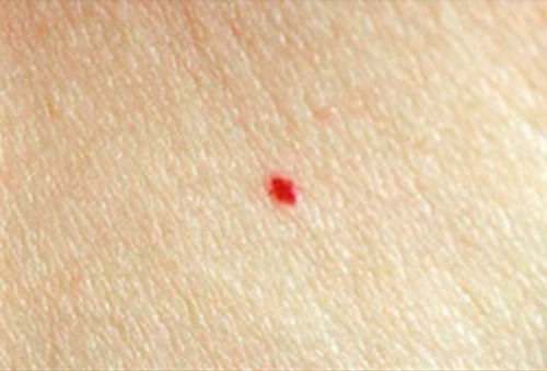 what causes cherry angiomas