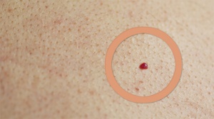 What Causes Cherry Angiomas?
