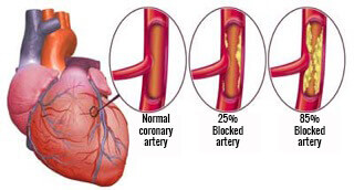 Image of arteries healthy artery compared with blocked artery