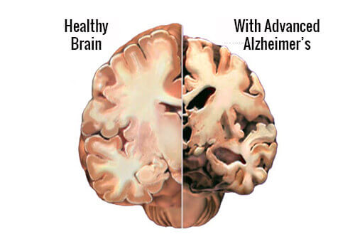 Side by side brain with advanced alzheimer's and healthy brain detect alzheimer's