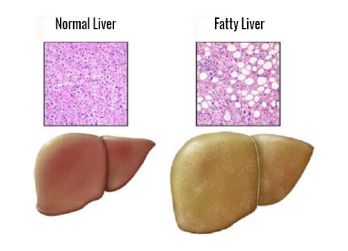 A fatty liver and a normal liver.