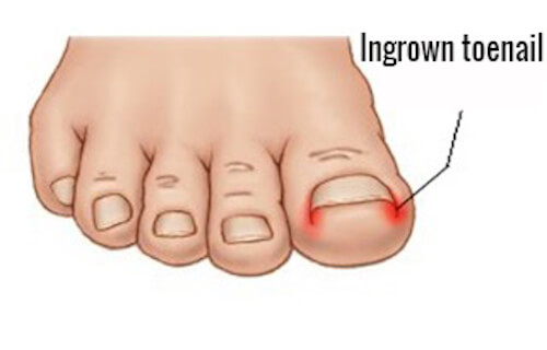 A drawing of an ingrown toenail.