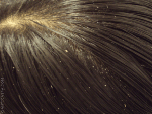 Natural Remedies That May Help Fight Dandruff