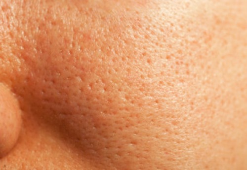 Natural Treatments for Enlarged Pores