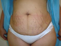 stretch marks