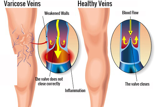 varicose veins have weaker walls than healthy veins so the blood doesn't flow as well.