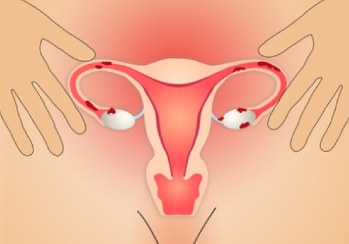Remedies, Symptoms and Causes of Endometriosis