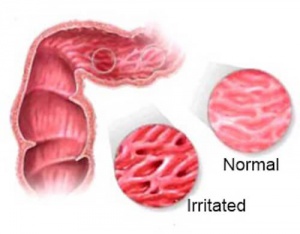 Infusions to Alleviate the Symptoms of Irritable Bowel Syndrome