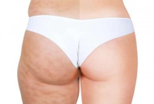 Natural Massage to Reduce Cellulite