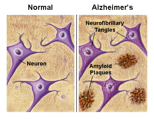 Foods that May Protect Against Alzheimer's