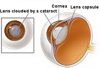 How to prevent cataracts