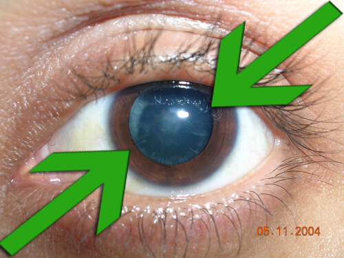 How Prevent Cataracts Naturally