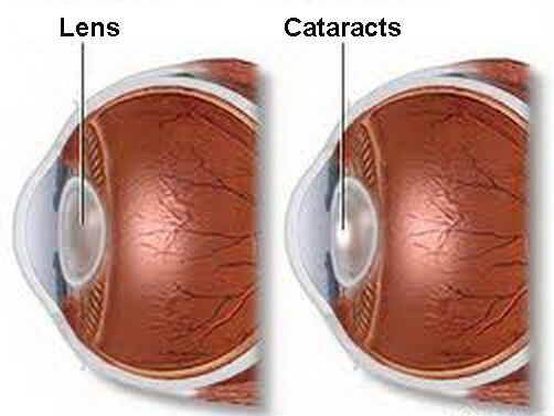 How cataracts are formed