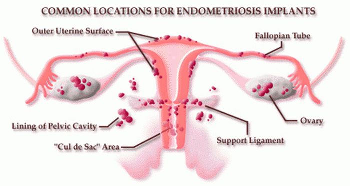Common locations for endometriosis implants.